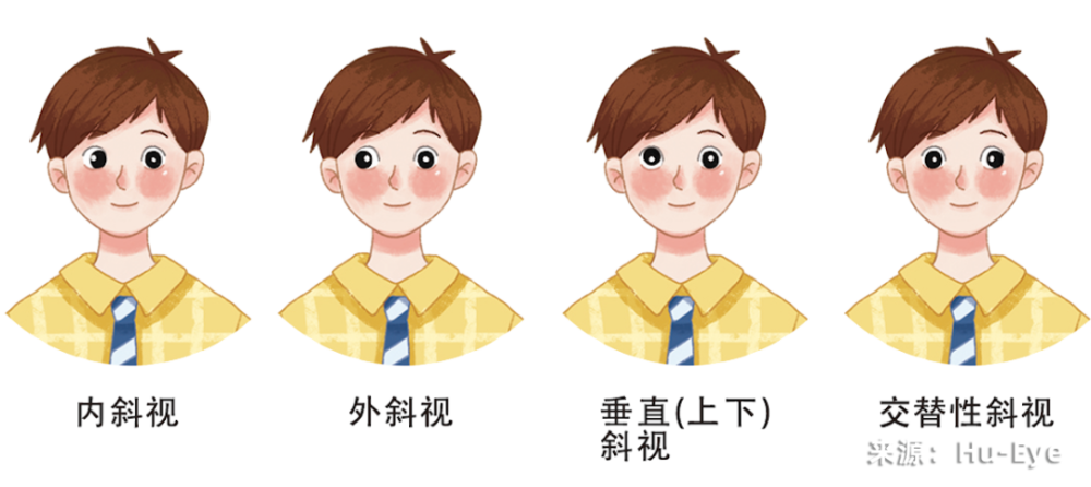 斜视.jpg